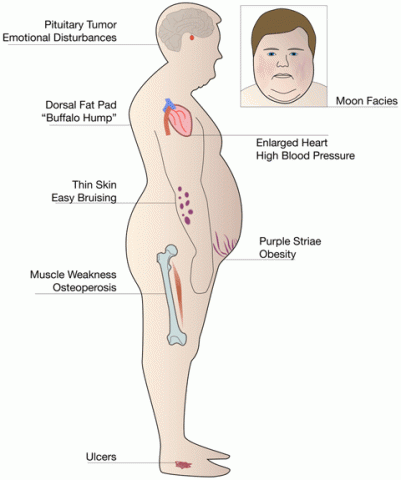 Cushing's Syndrome Physical Signs Cushing's Syndrome Physical Signs