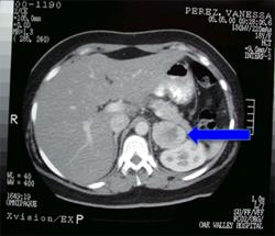 CAT scan of Pheochromocytoma CAT scan of Pheochromocytoma