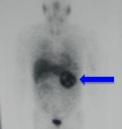 Pheochromocytoma on MIBG scan Pheochromocytoma on MIBG scan