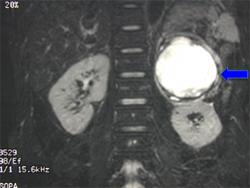 Pheochromocytoma on MRI Pheochromocytoma on MRI
