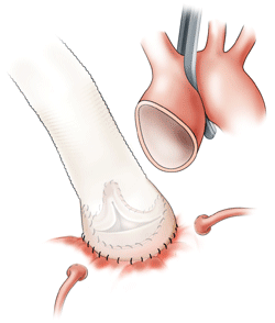David Procedure Step 3