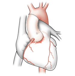David Procedure Step 4