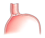 Normal LES valve keeps food in stomach.