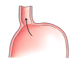 Weak LES valve allows food to wash back into esophagus